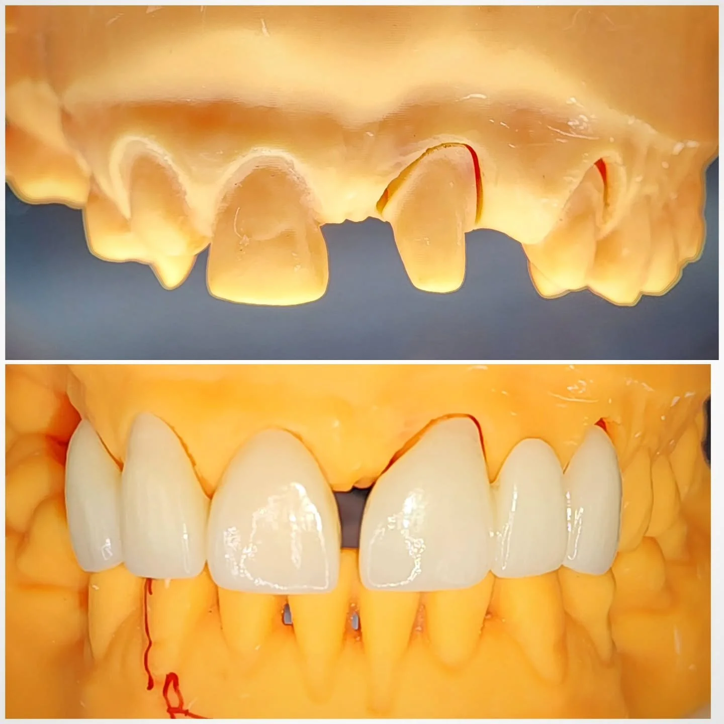 A beautiful anterior transformation, involving a 3-unit e.Max bridge, 2 veneers, and a crown, for a client in Westmeath. Gorgeous work!