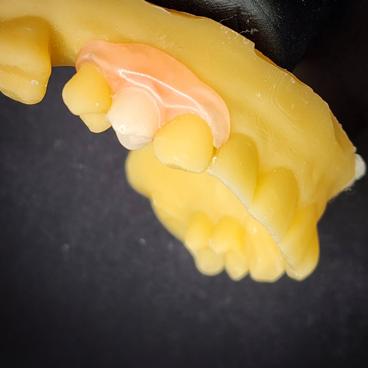 A tiny flexible partial denture, replacing an upper premolar. 🦷✨ #denture #premolar #valplast #dentistry