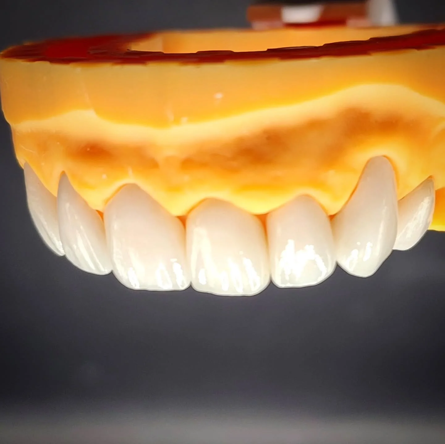 A set of 8 upper anterior e.Max porcelain veneers, in super-white BL4 shade with incisal translucency. Beautifully realistic work. ✨🦷

#veneers #dentistry #smile #beauty #teeth