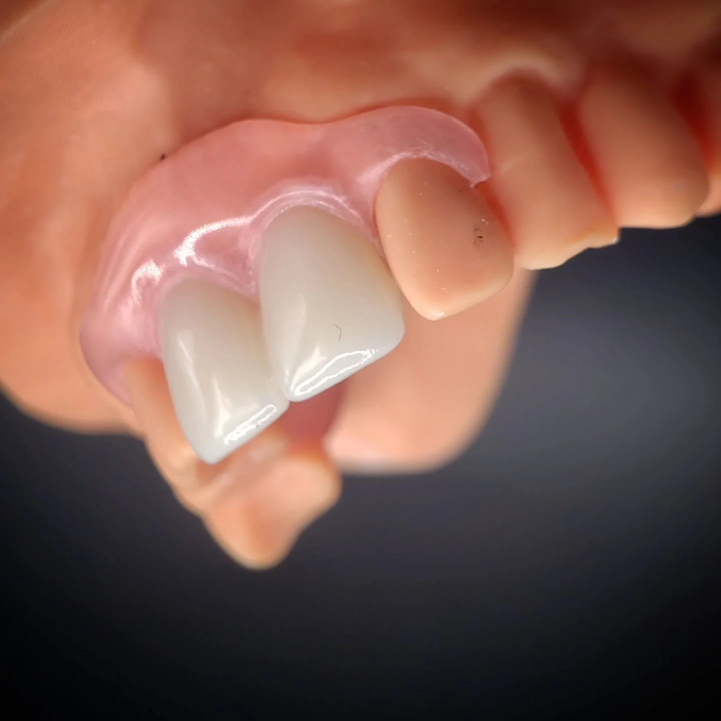 A nice little Valplast flexible denture, to replace the central incisors and restore the gingival profile, for this patient from West Cork.