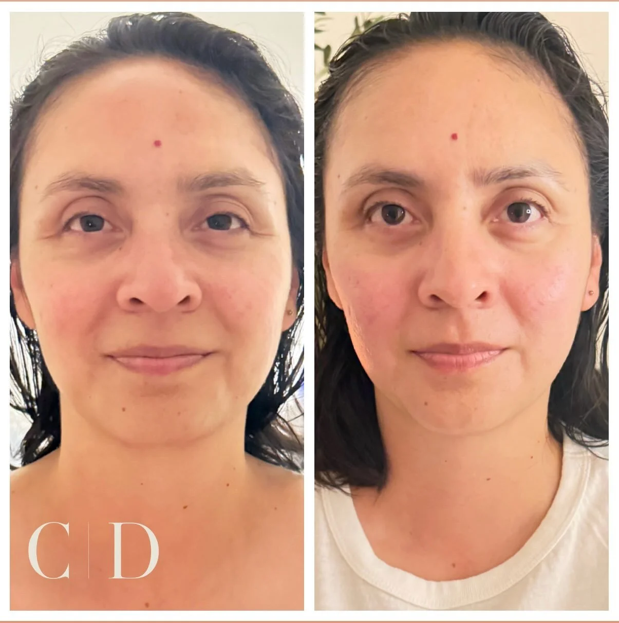 One treatment. That&rsquo;s all it took. ✨

Every time I see a transformation like this I&rsquo;m reminded how simple skincare and beauty can be - the lift along the jawline, the brightness that comes back to the skin, the way the whole face just&hel