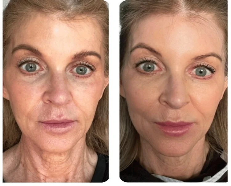 Side-by-side comparison of a woman's cheek before and after skincare treatment, highlighting acne improvement.