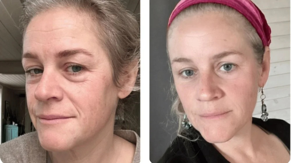 Before and after comparison of a woman's face, showing improvement in the appearance of her eyebrows over 69 days. Licensed by Osmosis, LLC.
