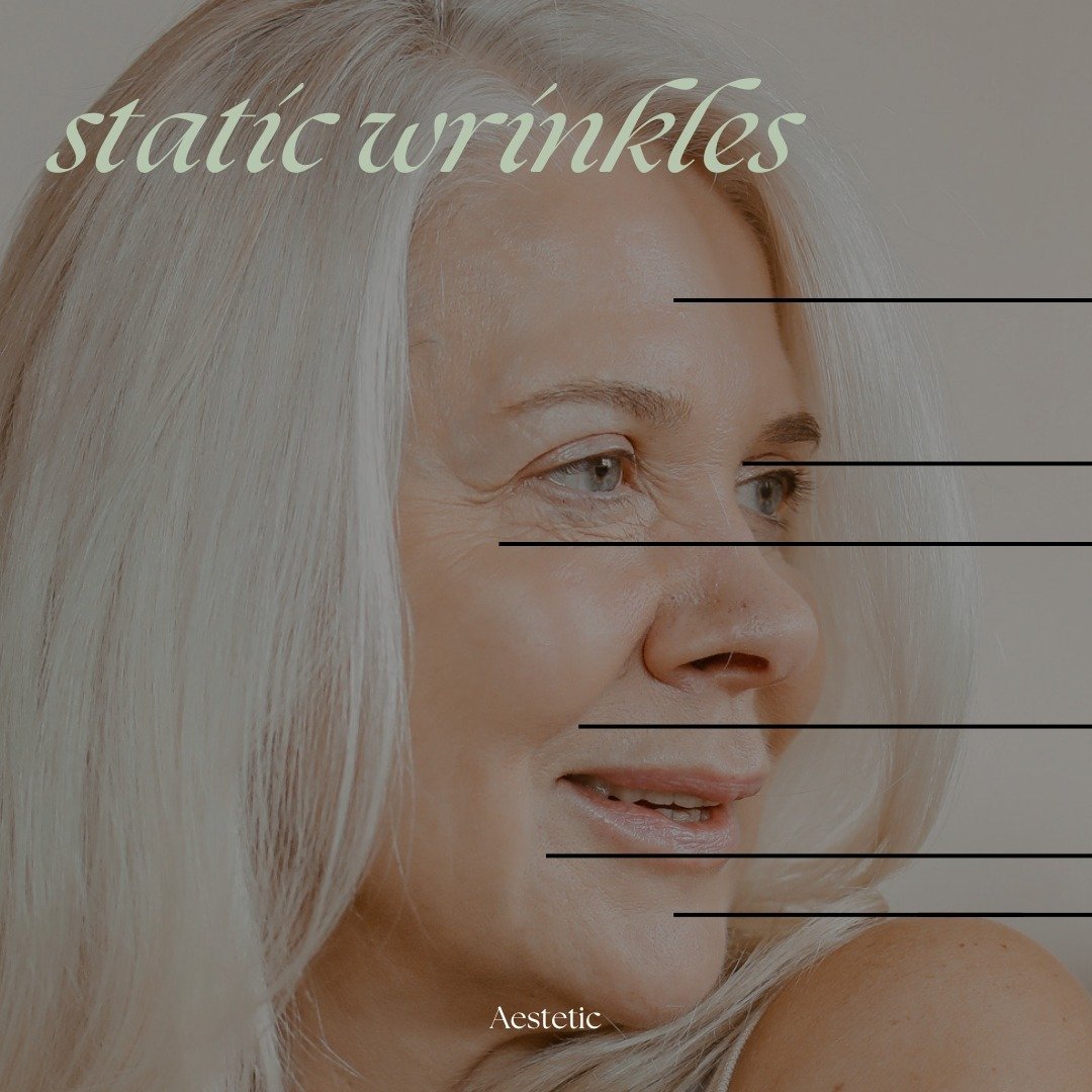 Noticing wrinkles when your face is at rest? ⁠
⁠
Let's delve into the world of static wrinkles to demystify their origins and common locations on the face!⁠
⁠
SO... what are static wrinkles?⁠
Static wrinkles are those lines and creases that remain vi