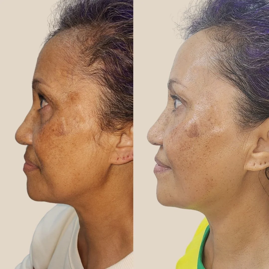 Pigmentation-focused skin rejuvenation