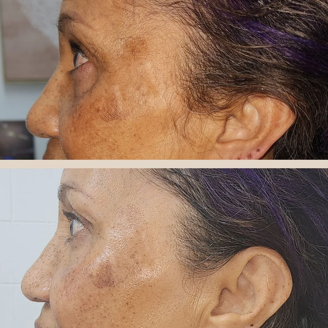 Pigmentation correction