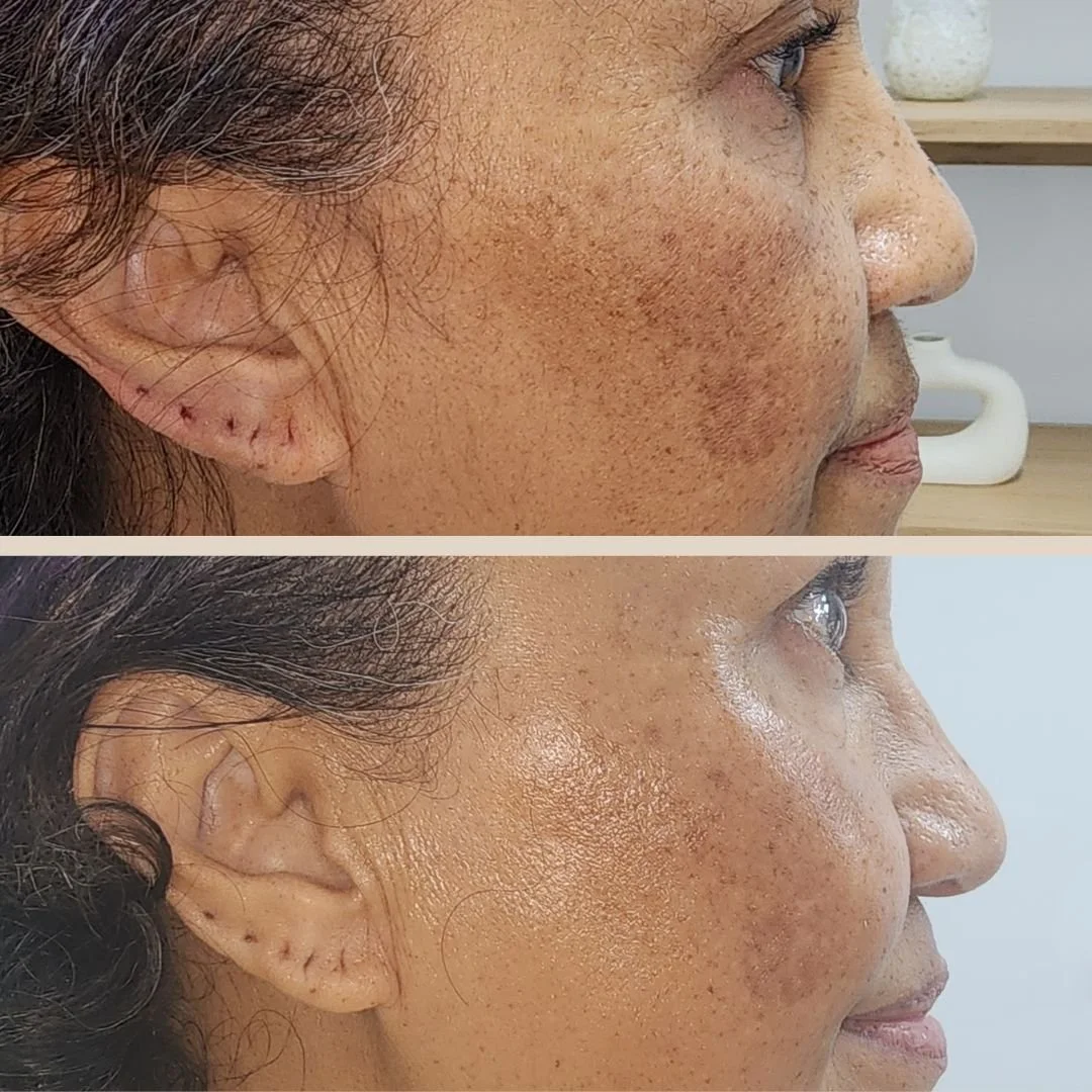 Uneven skin tone
