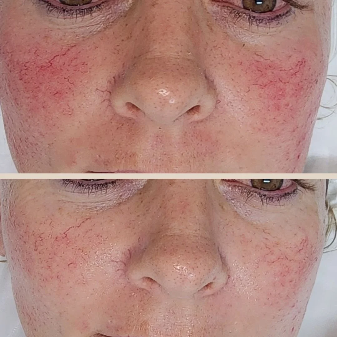 Sensitive skin & rosacea support treatment