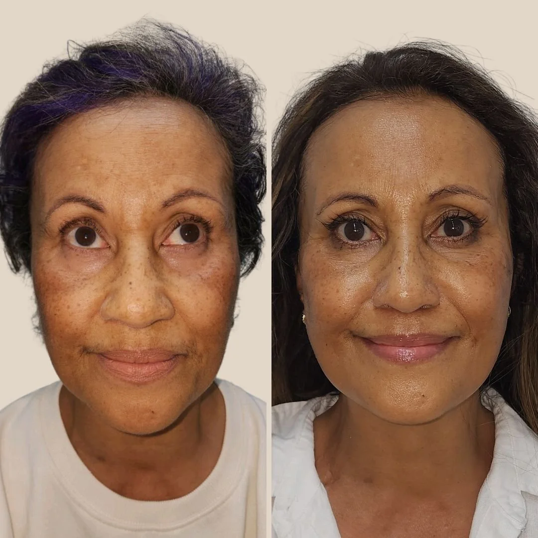 Advanced pigmentation & texture refinement