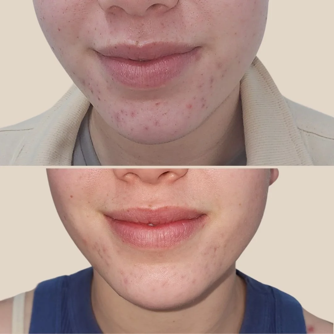 Acne-prone skin & inflammation support