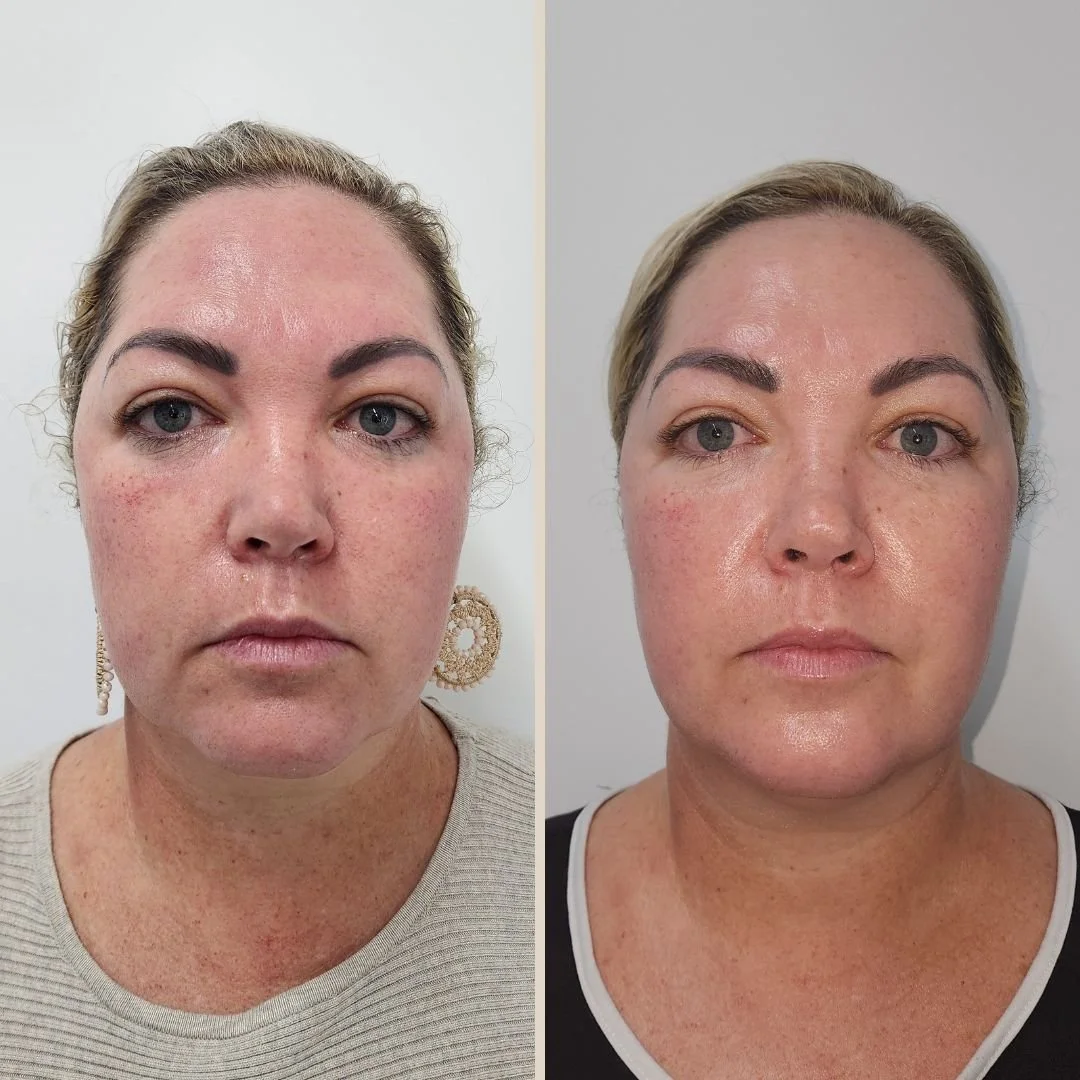 Redness reduction & barrier support