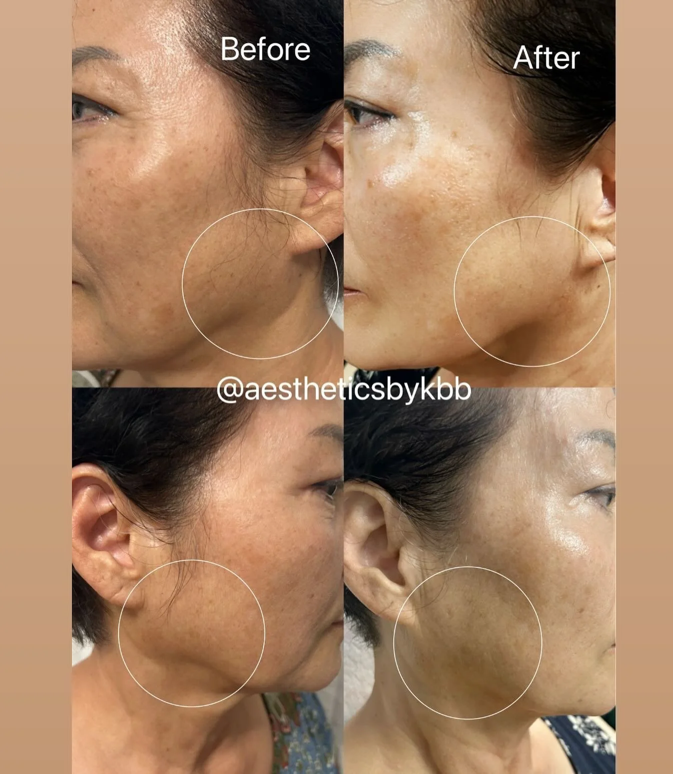This clients has been self-conscious for over a decade noticing bulging along the jawline below the ear which made her face look bigger and wider than how she used to be. She tried daily massages, creams, weight loss and nothing seemed to work. 
What