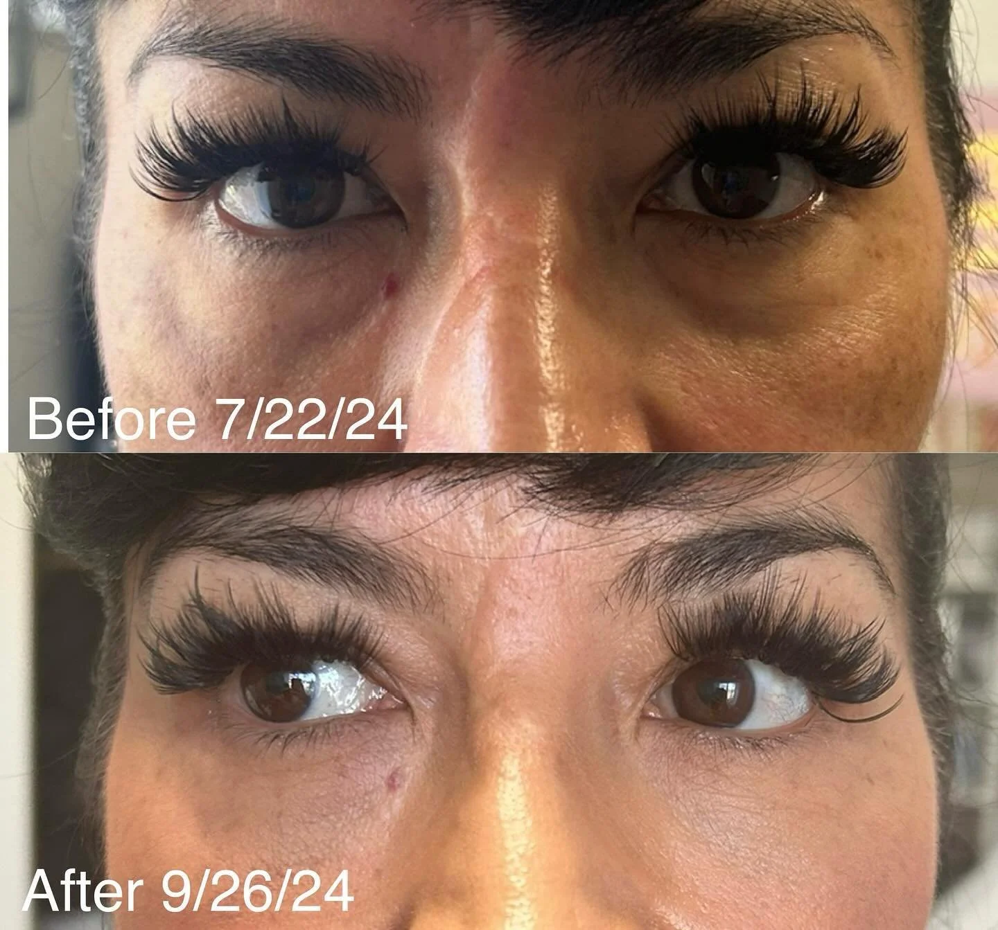 Look at the difference post 3 months with only 1 treatment of under eye PRF! She looks stunning~