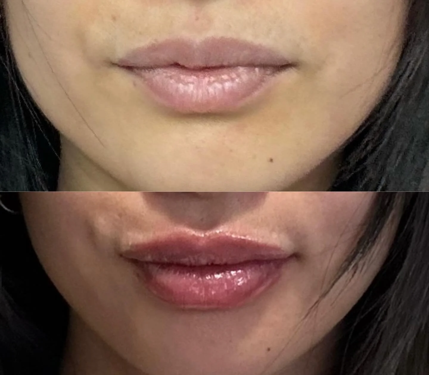 Freshly done lips 💋 
For this lovely gal, I enhanced her cupid&rsquo;s bow and even out her lips. She got her juicy lips with only half a syringe! But I know she will come back for more 🤣