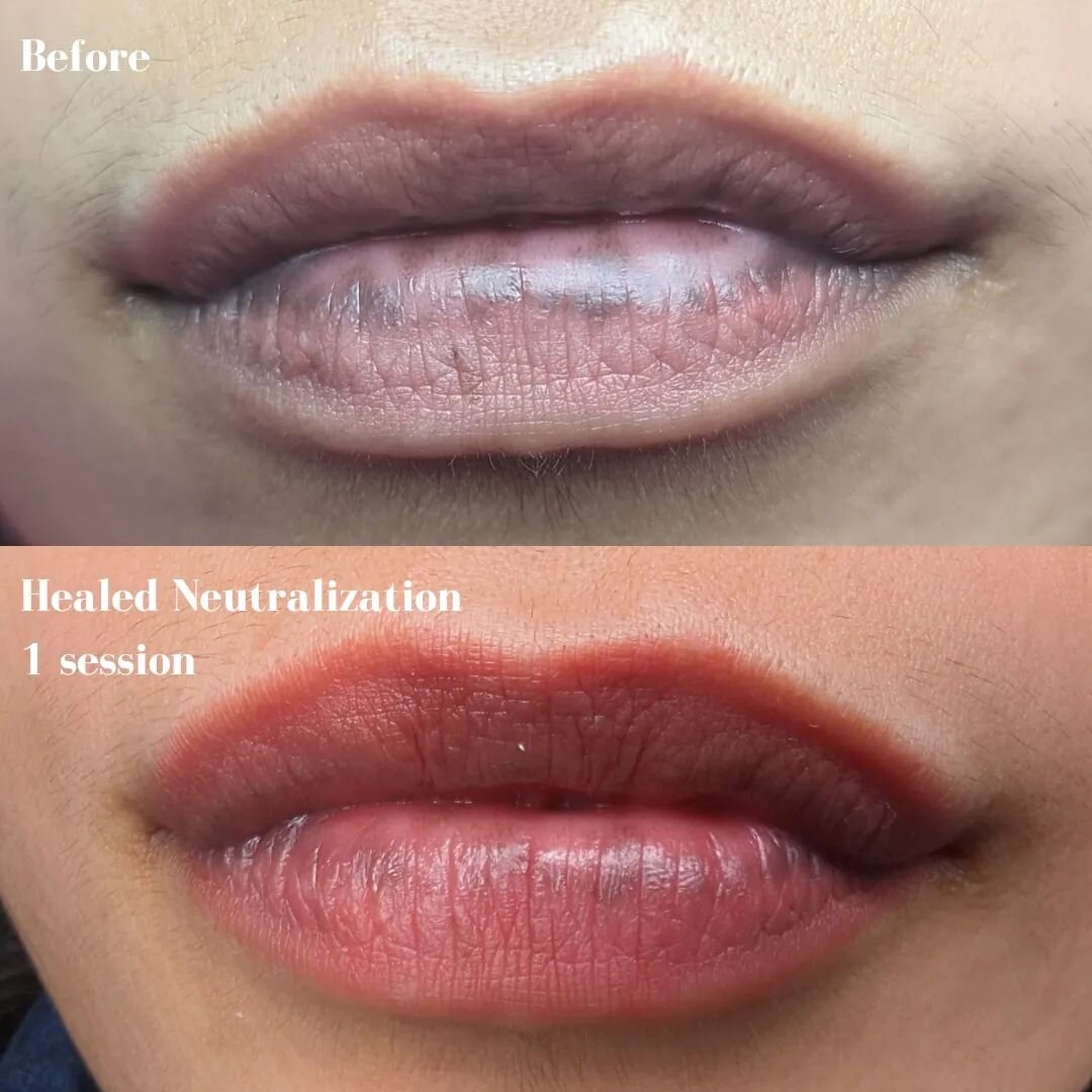 I'm proud of these healed results after just one Neutralization Session. This Client will still need 1-2 more sessions to fully neutralize. Neutralization is the process of neutralizing the hyperpigmentation found in some lips by bringing them to an 