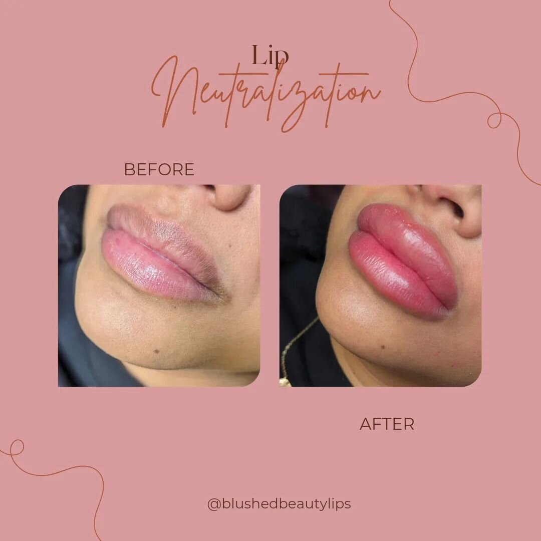 Can I just say I love Lip Neutralizations! Lip neutralizations are the process of neutralizing the hyperpigmentation found in some lips, by evening out the tone and bringing the lips to or more neutral pink tone. There are different degrees of hyperp