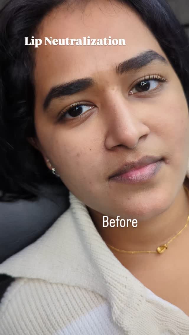 Lip Neutralization is the process of camouflaging darker or lighter areas in the lips and bringing the lips to a more uniform color. This more uniform color is usually based off of the natural undertones of the client's lips. Typically the inner bott