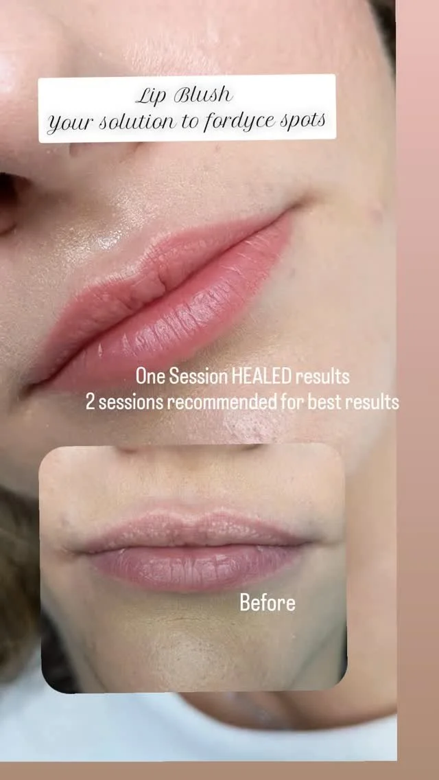 There are many reasons why people seek out lip blush one of them being as a way to camouflage their Fordyce Spots. These pesky enlarged oil glands can be lifelong or can seem to appear later in life naturally or after certain procedures like lip fill