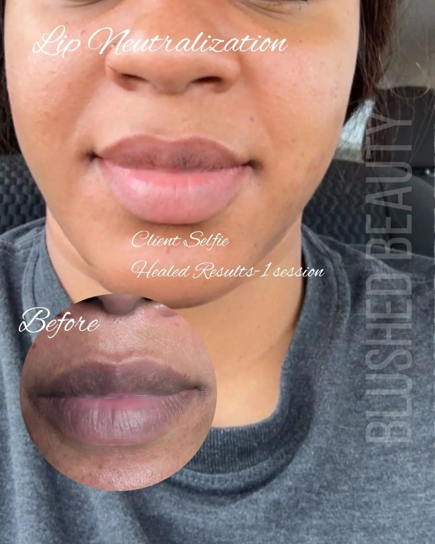 Let's Talk Lip Neutralization! Lip neutralization is the process of achieving a more uniform color to your lips. For some people that may mean camouflaging dark areas and achieving a &quot;pinker&quot; overall color. Typically this color is determine