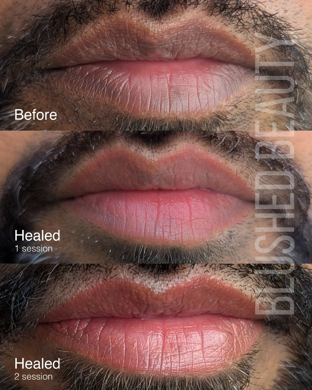 💋 Lip Neutralization &mdash; progress, not instant perfection

This is an example of lip neutralization, a specialized PMU service designed to correct hyperpigmentation and create a more even, natural lip tone. Rather than adding bright color, we ca