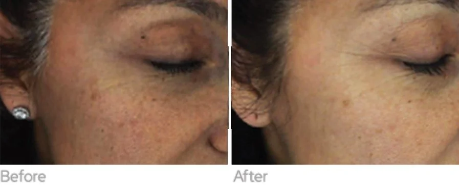 Exosome Microneedling Mount Prospect