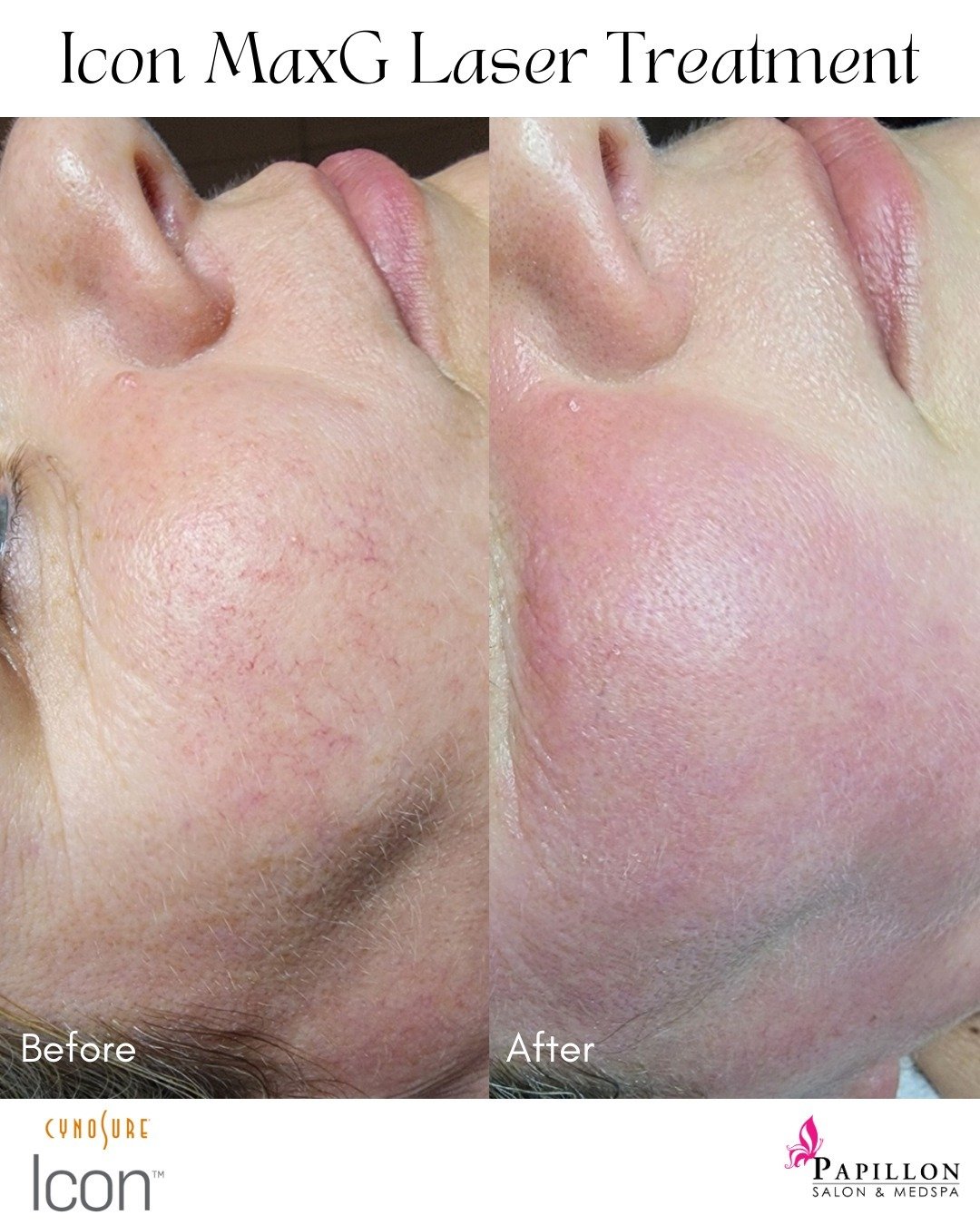 We understand the frustration of dealing with telangiectasias, but don't let it hold you back from feeling confident in your own skin. Here, at Papillon MedSpa, our laser treatment effectively targets and reduces those pesky red lines, leaving you wi