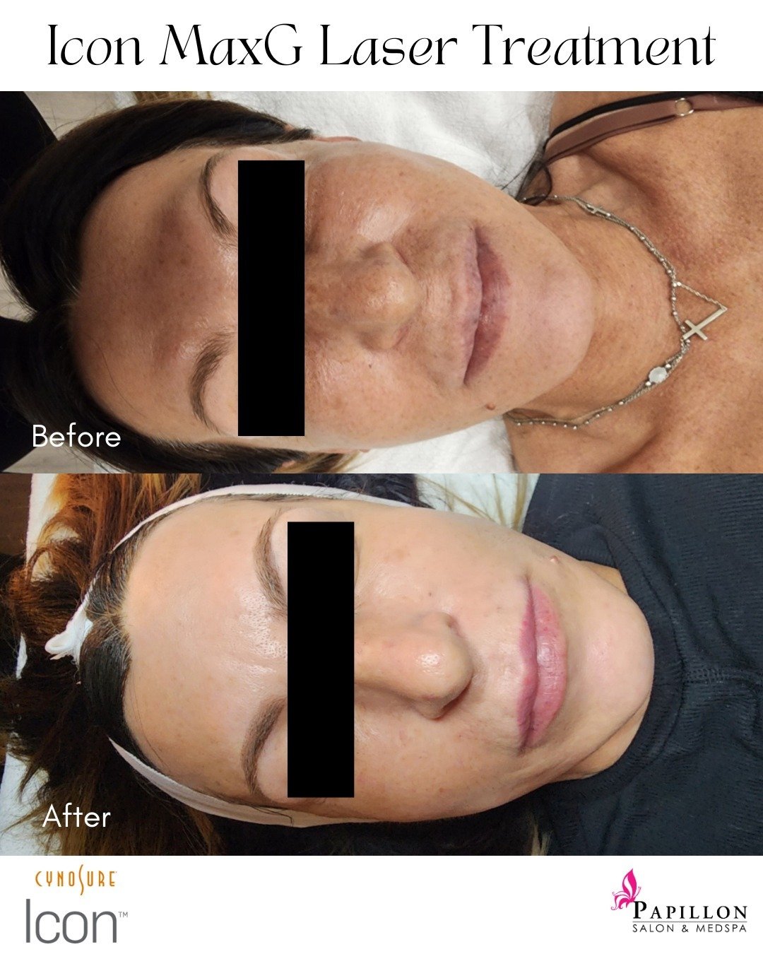 Say goodbye to skin pigmentation and sunspots with Icon MaxG Laser treatment! Our beautiful client has seen a remarkable difference in her skin. Just take a look at these before and after photos, pigmentation gone, plus more youthful glow and brightn