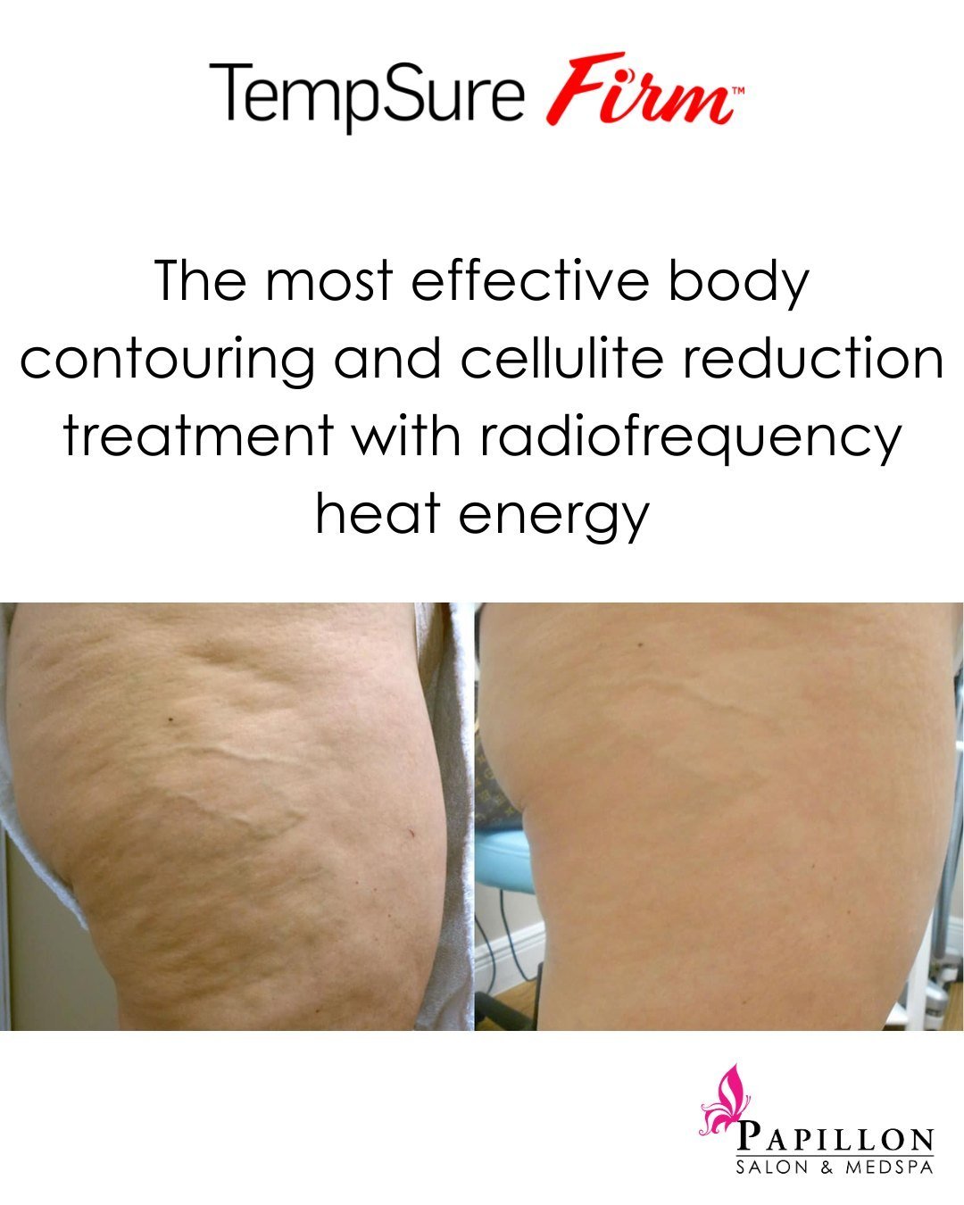 Transform your body with TempSure Firm! Say goodbye to cellulite and hello to smooth, contoured skin. Our state-of-the-art device uses radiofrequency heat energy to target and eliminate fat cells while promoting collagen production for a tighter, fir