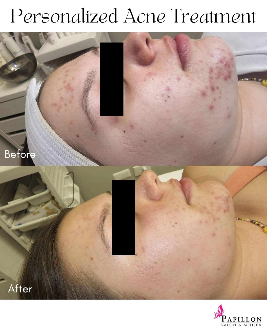 As a teenager or adult, dealing with acne can be frustrating and overwhelming. But here's the thing, there is no one size fits all when it comes to treating acne. Everyone's skin is different and requires personalized treatment. That's why at Papillo