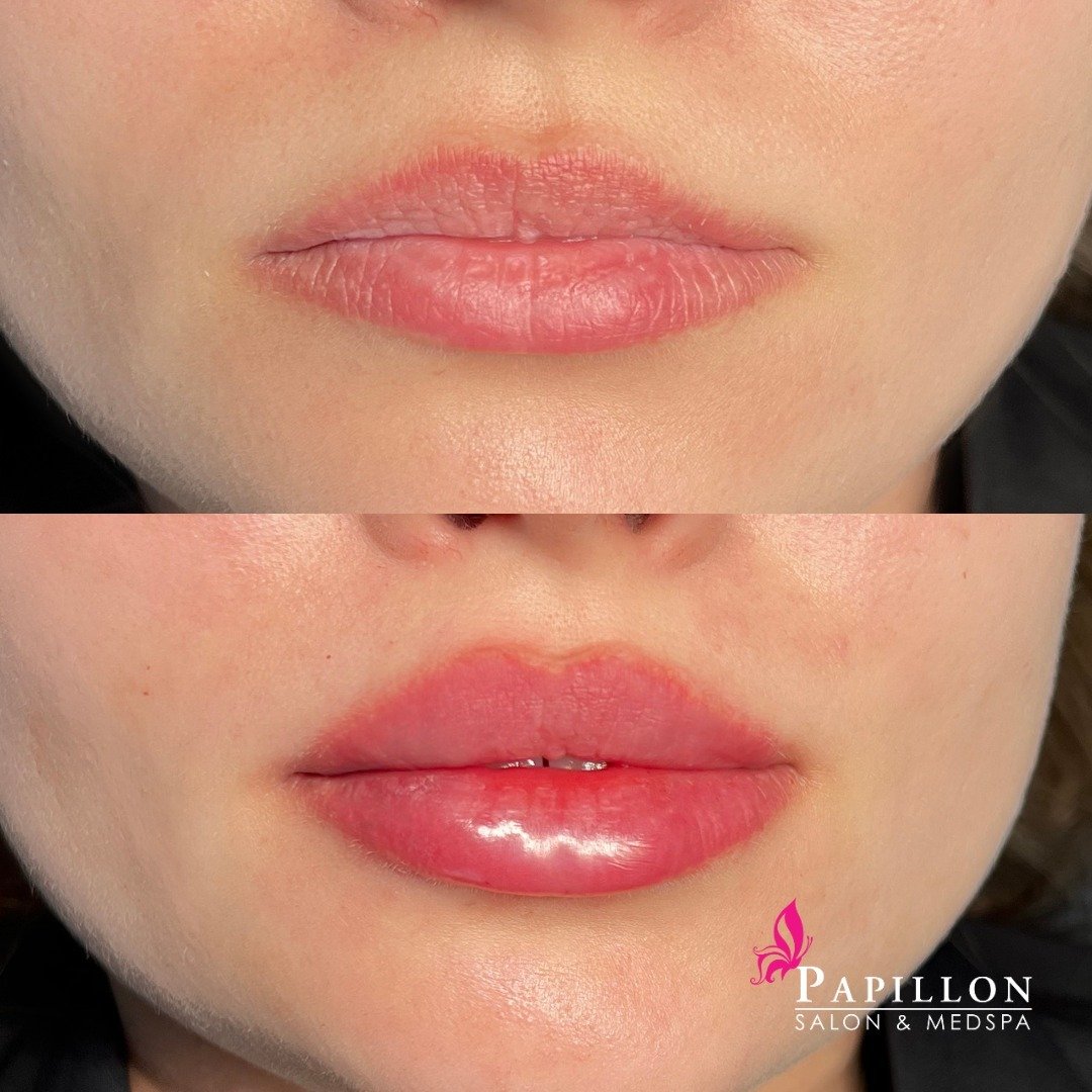 💋 Lips to Love! 💖 Witness the magic of a lip filler transformation right before your eyes. Pat, our Aesthetic Nurse Specialist, works wonders that leave you speechless.

Ready for your own transformation? Book your appointment with Pat today.
Give 