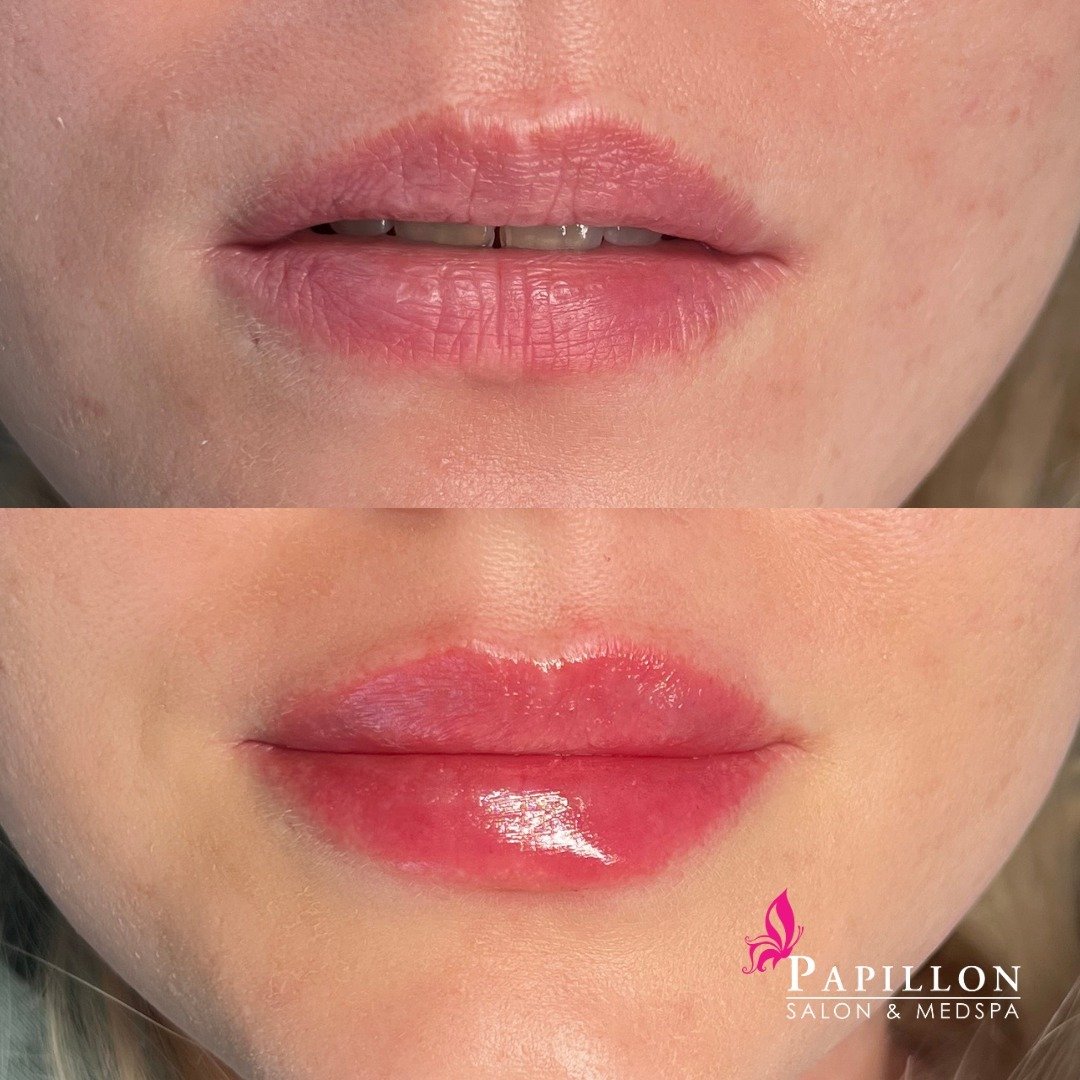 💋 Transform your pout with confidence at Papillon MedSpa! Our Aesthetic Nurse Specialist, Pat, is here to safely enhance your lips with our top-of-the-line lip filler treatments. Just take a look at the stunning results in this photo!

Don't wait an
