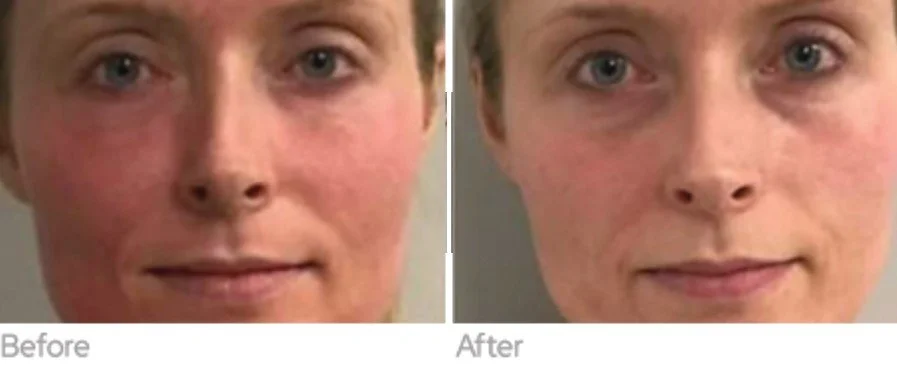 Exosome Microneedling Mount Prospect