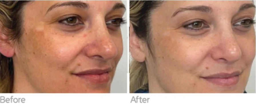 Exosome Microneedling Mount Prospect