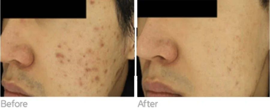 Exosome Microneedling Mount Prospect