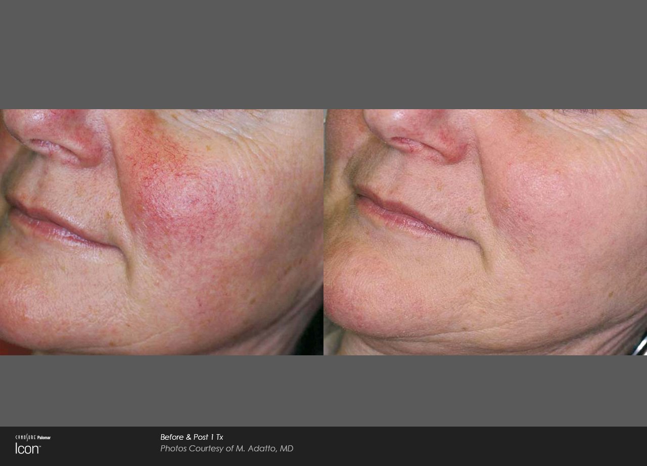 Skin-Revitalization-Before-After-Photo-5.jpg