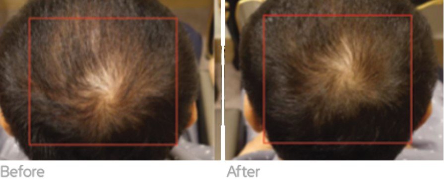 Exosome Microneedling Mount Prospect