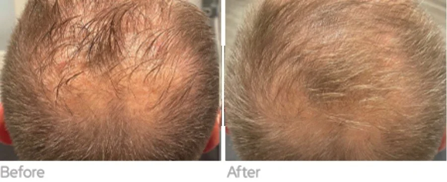 Exosome Microneedling Mount Prospect