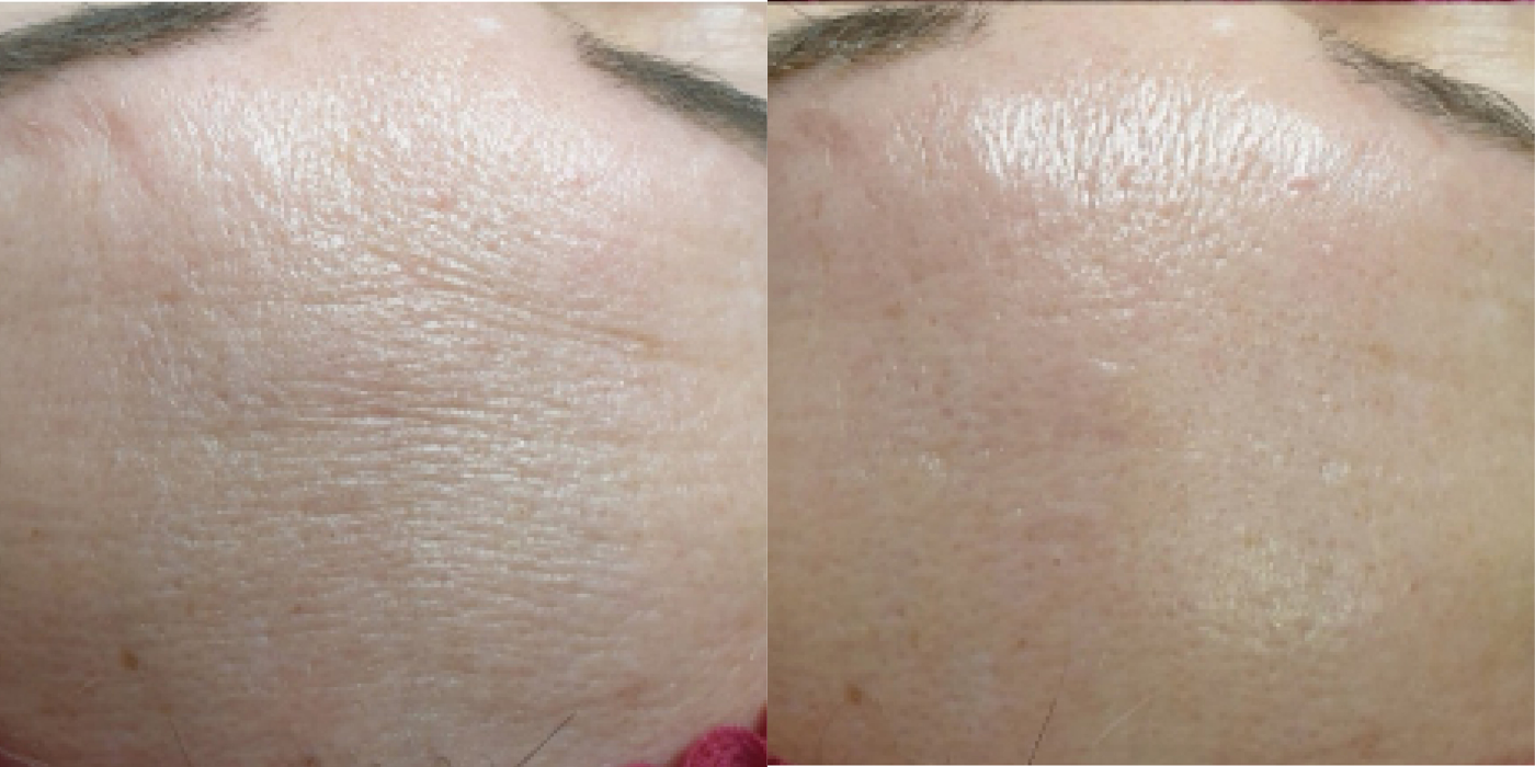 BioRePeel Treatment in Mount Prospect, IL | Papillon MedSpa