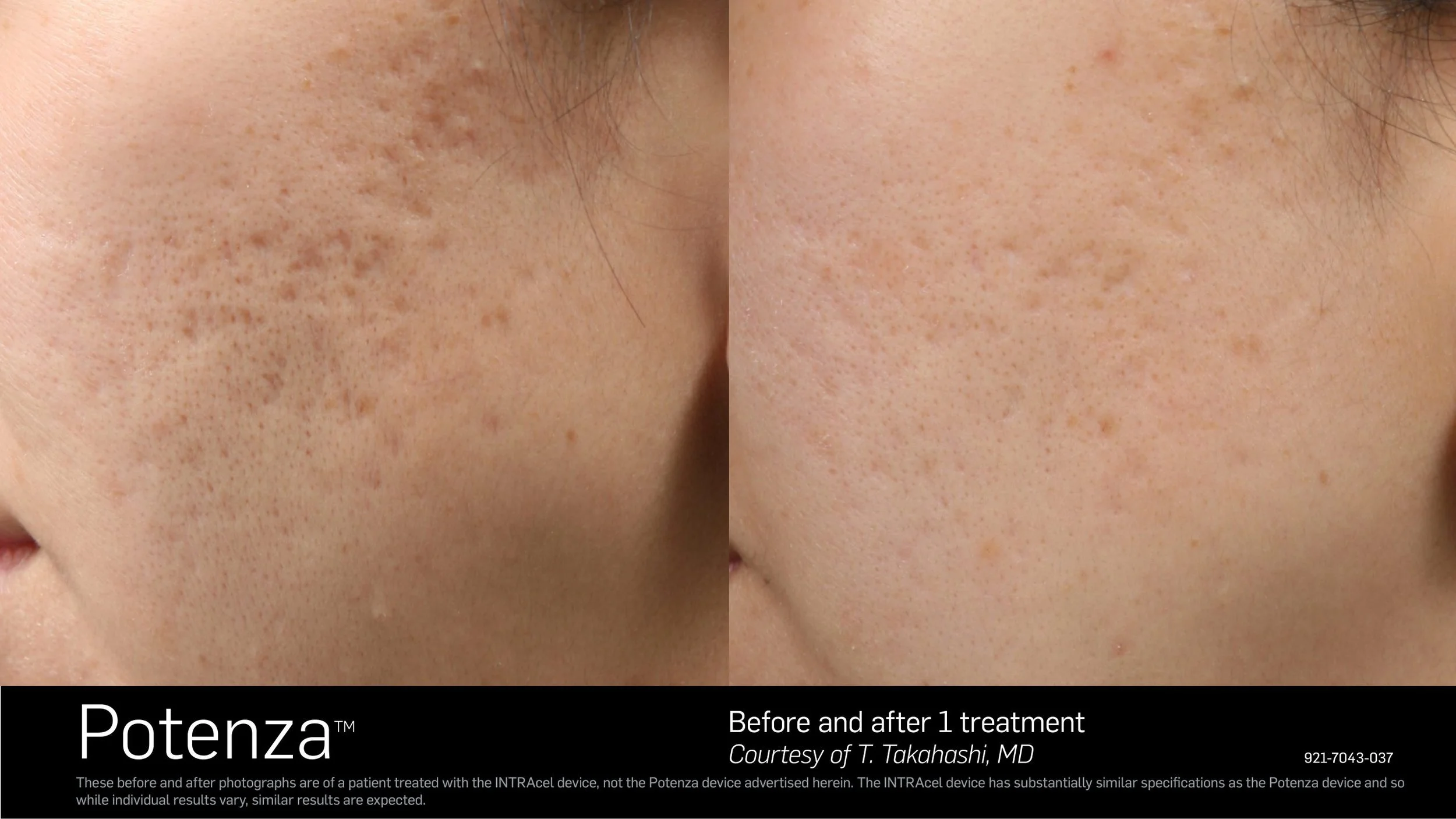 Potenza RF Microneedling results Mount Prospect