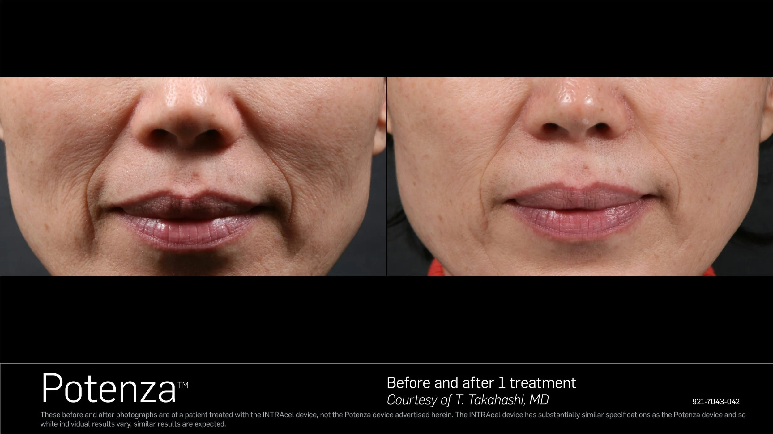 Potenza RF Microneedling results Mount Prospect