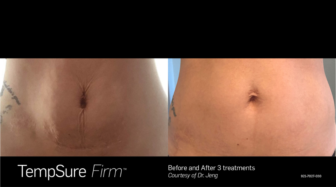 Body contouring and TempSure Firm by Papillon MedSpa in Mount Prospect