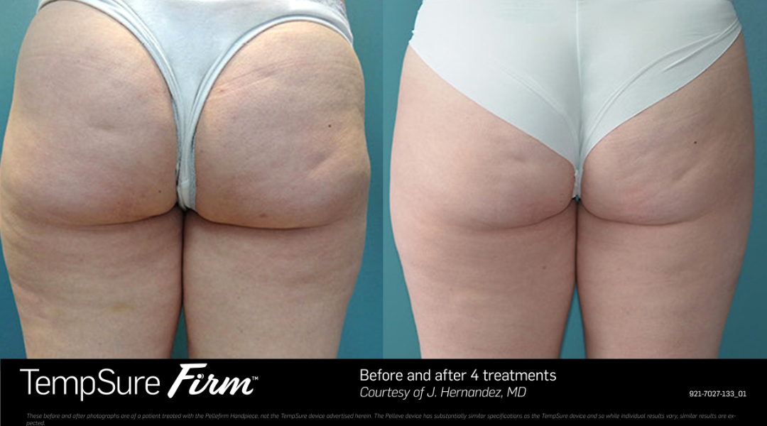 TempSure_Firm_Mount_Prospect (5).png
