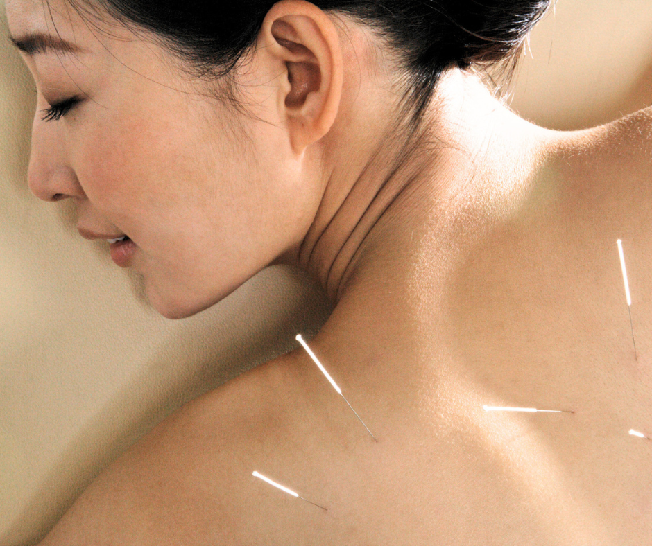 Holistic acupuncture treatment for stress relief and wellness at Bliss Studio Austin.