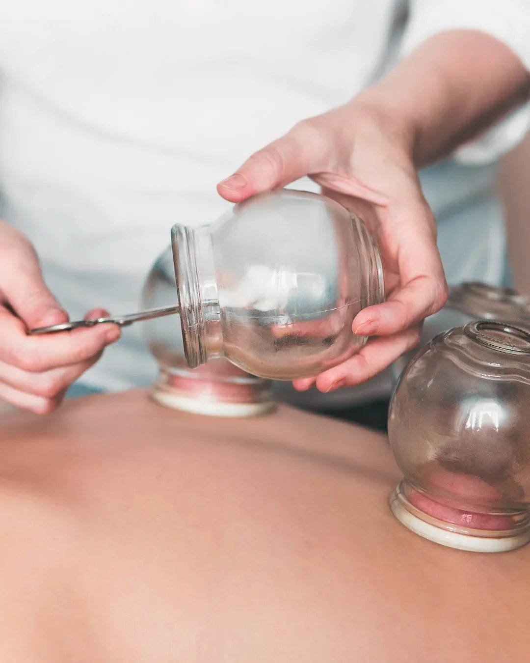 Traditional cupping therapy used alongside chiropractic care for muscle tension release.