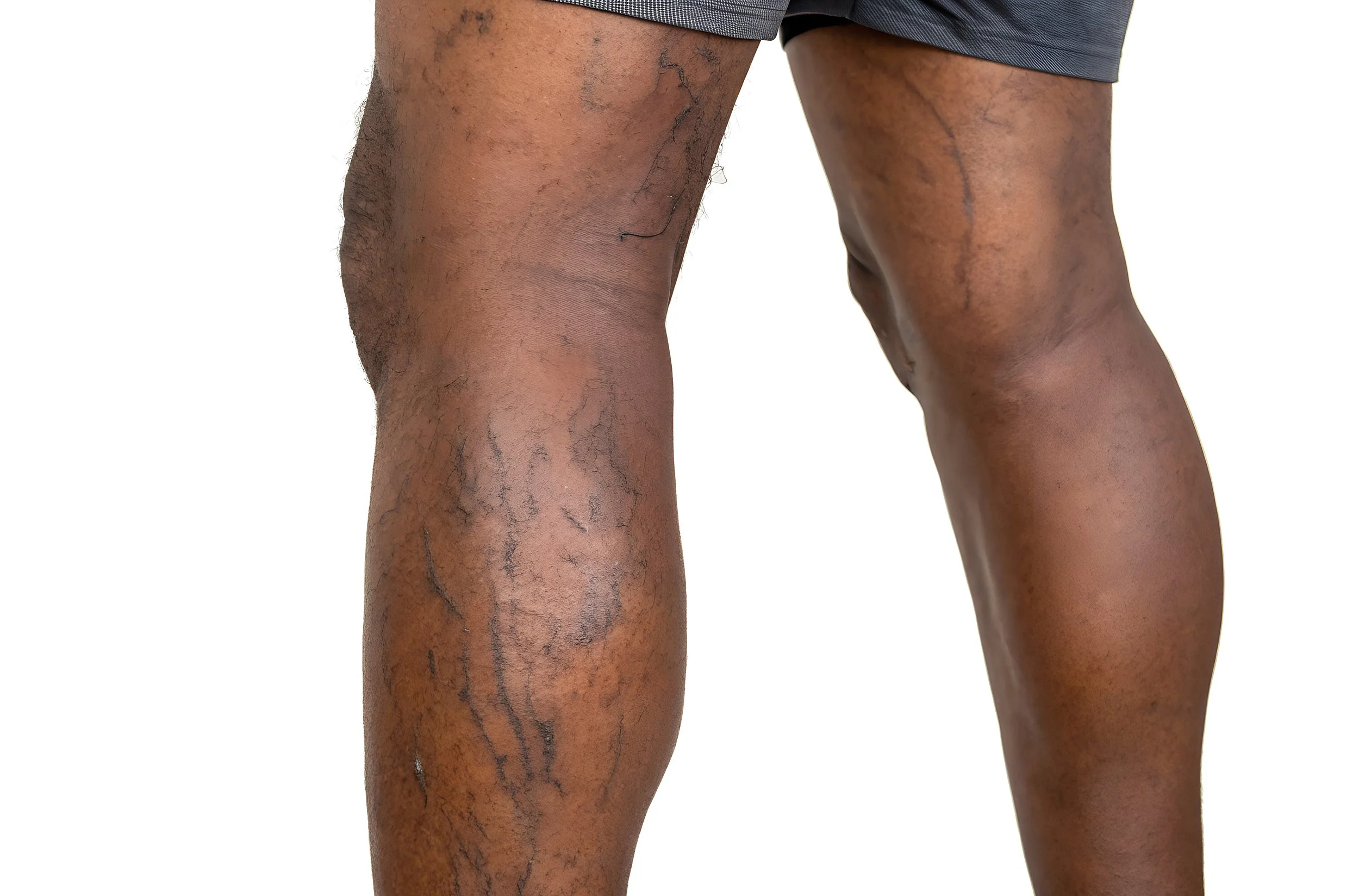 Close-up of a person's legs with visible varicose veins, standing against a white background.