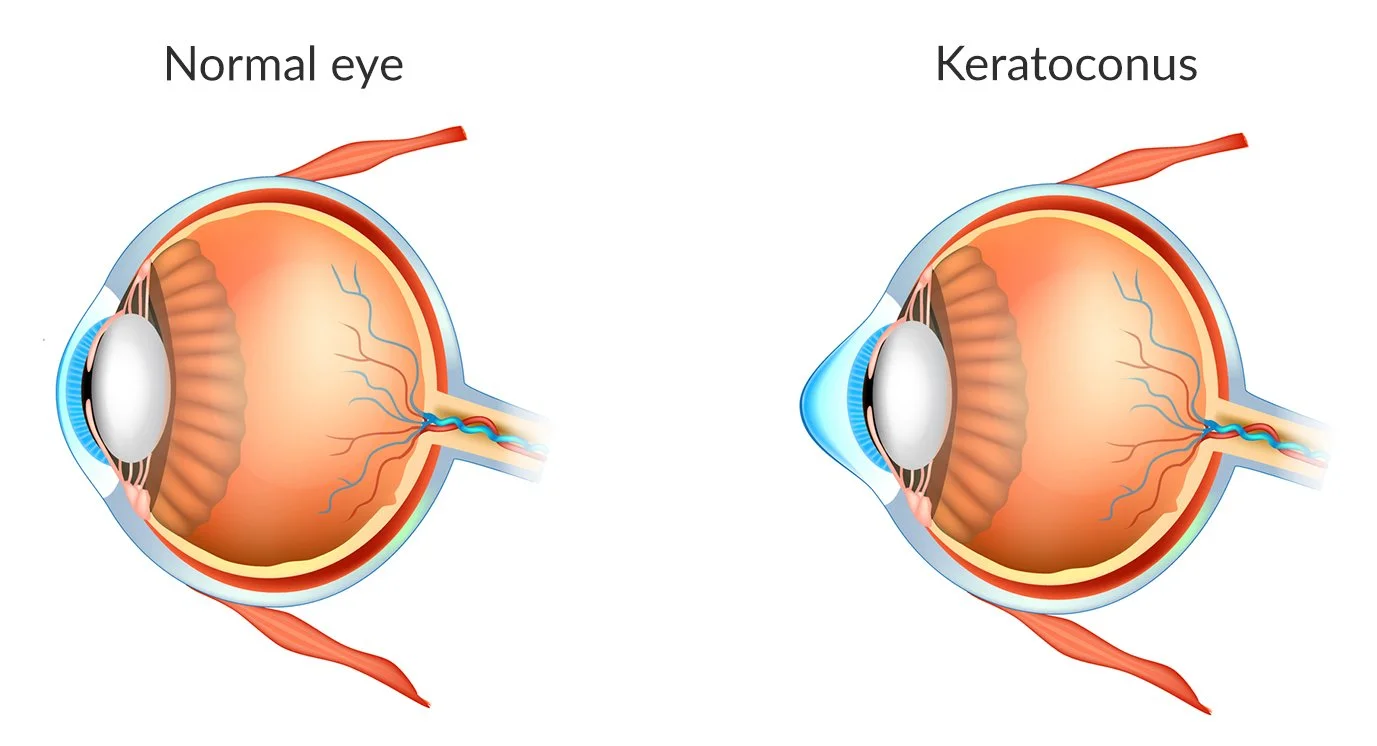 Keratoconus Brisbane Ophthalmologist — Dr David Gunn · Brisbane
