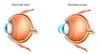 NEW KERATOCONUS TREATMENT AUSTRALIA: CAIRS - CORNEAL ALLOGENIC ...