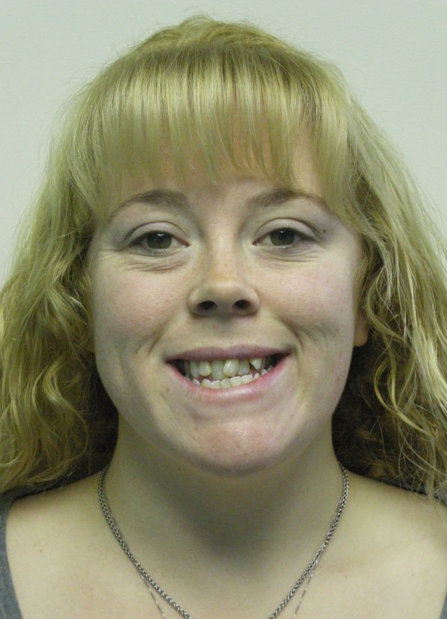 beecroft-patient-Tiffani-C-before.jpg