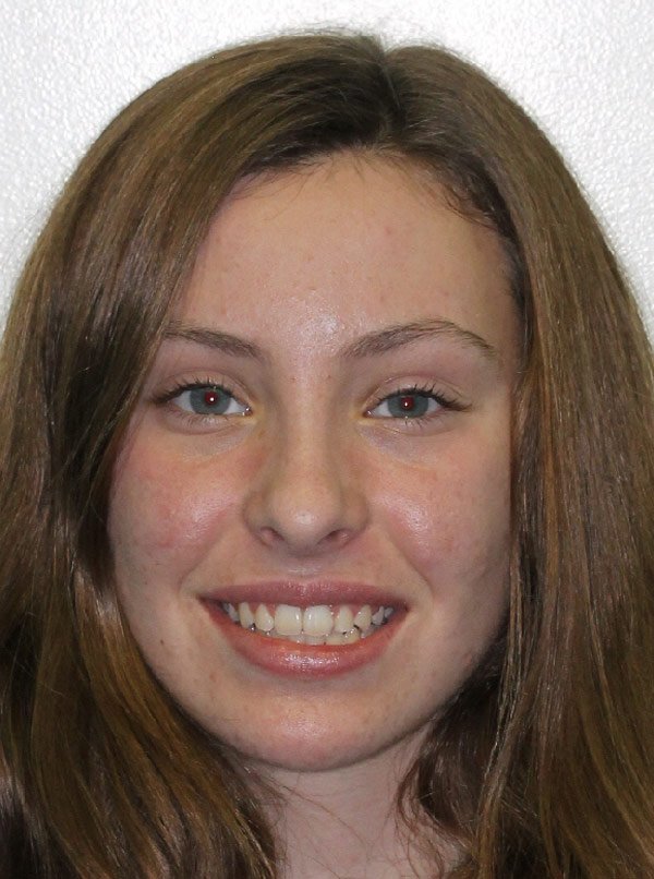 beecroft-patient-Hannah-H-Frontal-Smile-after.jpg