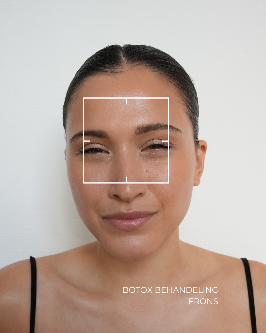 botox frons behandeling na